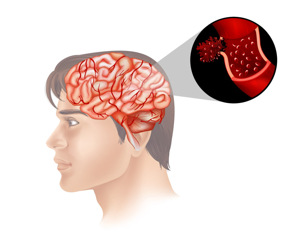 Encephalitis (मस्तिष्क की सूजन) Treatment in Kanpur
